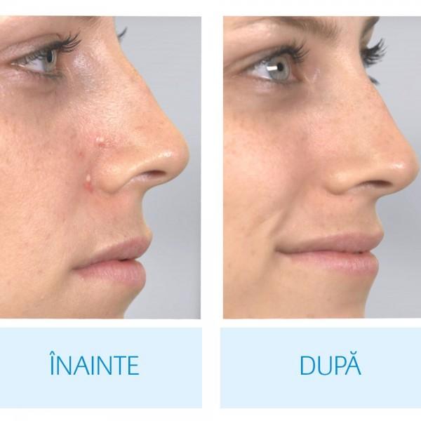 Aspirator facial, pentru un ten curat